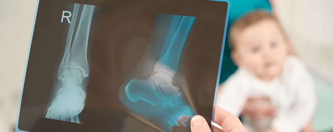 Specialist examineaza radiografia membrului inferior al unui copil