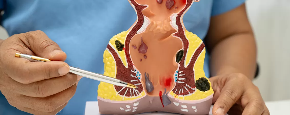 Medic explica anatomia rectului si modificarile produse de hemoroizi