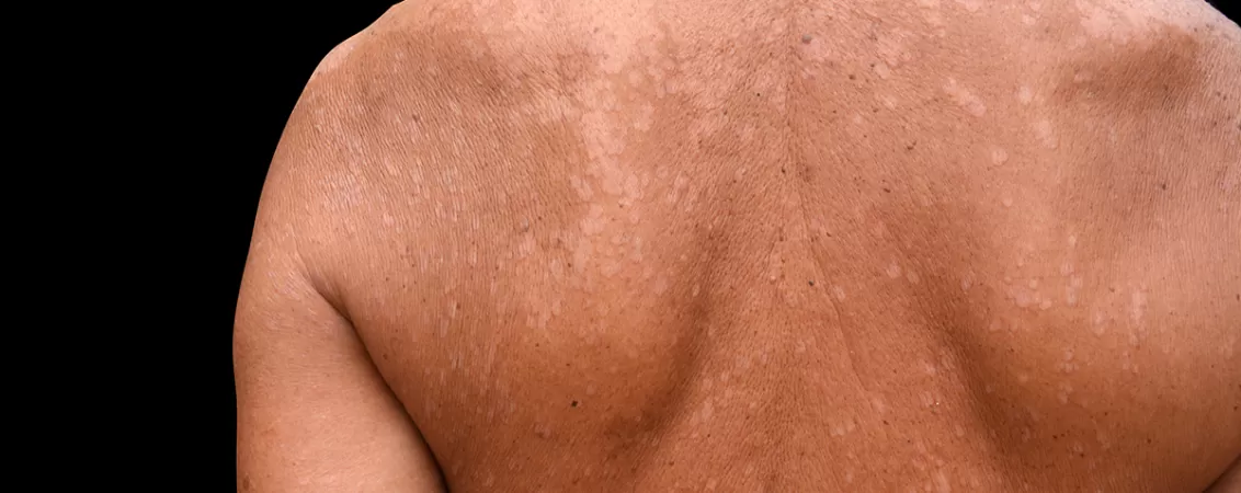 Tinea versicolor