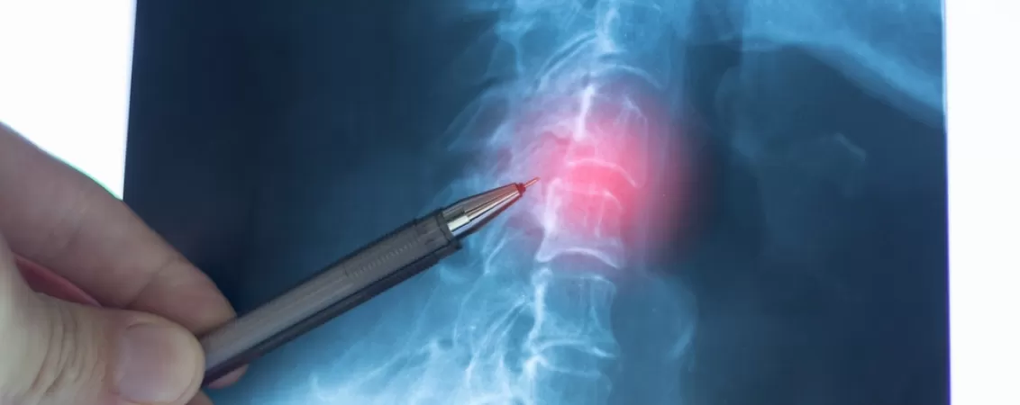 Un medic analizeaza o radiografie care evidentiaza deplasarea discurilor intervertebrale si hernia la nivelul coloanei cervicale