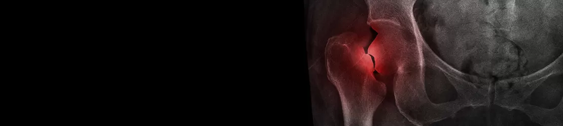 radiografie fractura pertrohanteriana