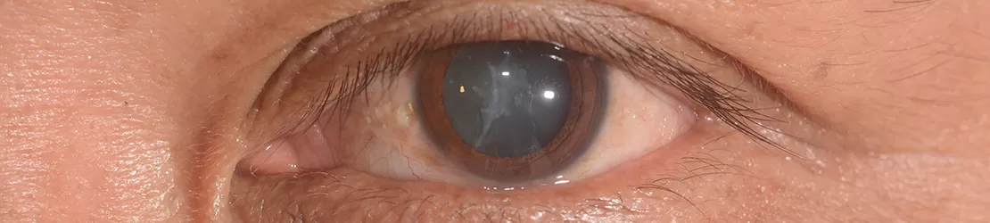 ochi afectat de cataracta