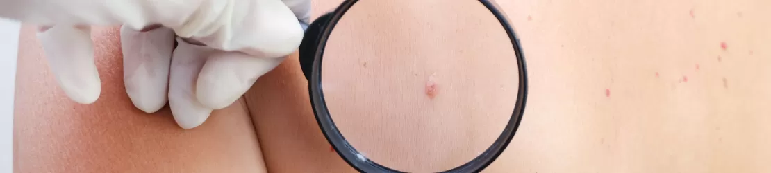 Consult dermatologic pentru leziuni vasculare