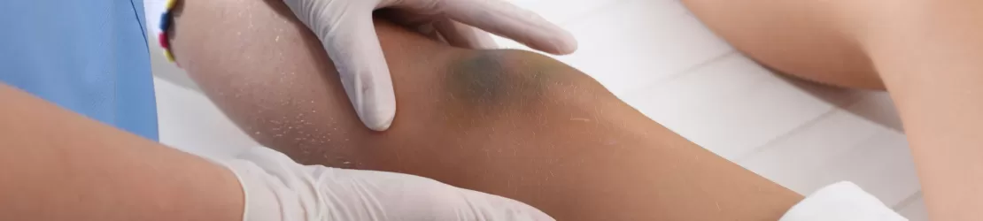 Copil mic cu o contuzie la genunchi
