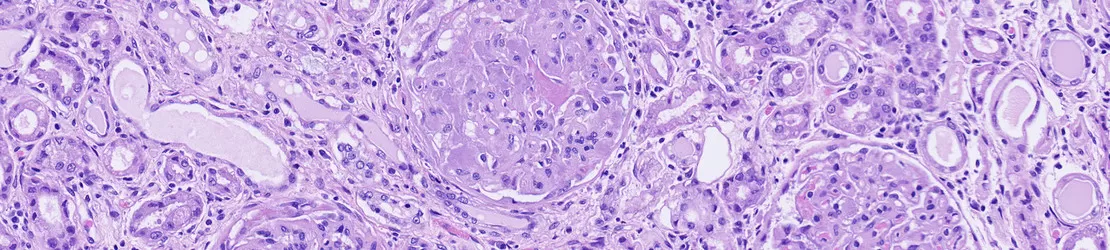 Imagine microscopica cu depunere de amiloid pe rinichi