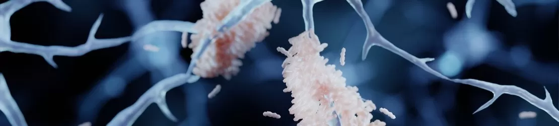 acumulare de amiloid pe neuroni