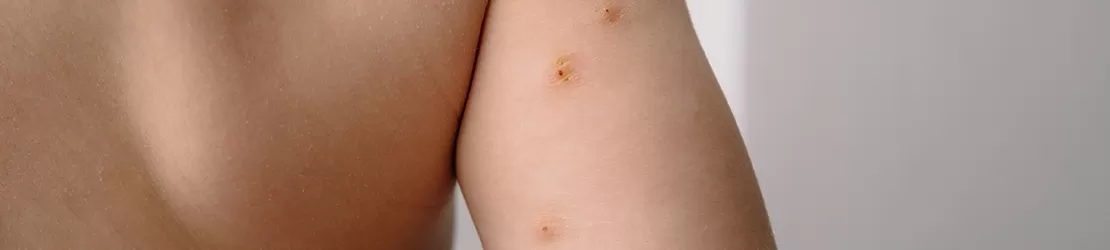 copil cu leziuni cauzate de Molluscum Contagiosum