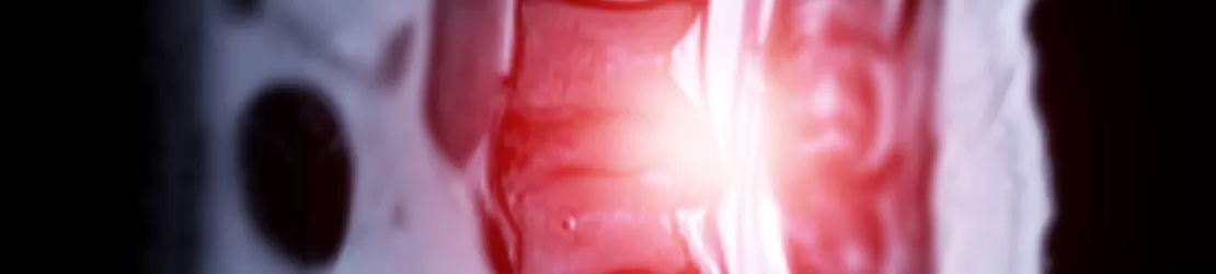 imagine RMN a zonei lombare a coloanei vertebrale