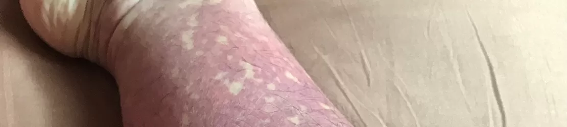 imagine cu picior afectat de Purupura Henoch-Schonlein