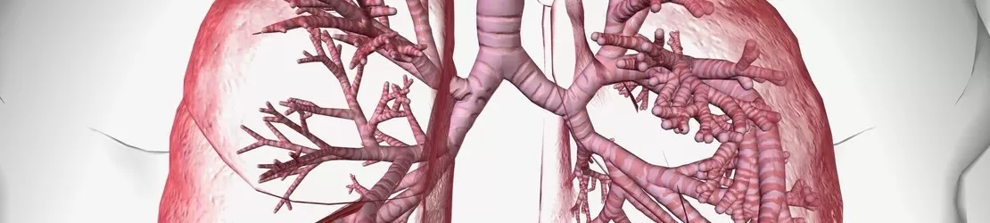 inflamatie a plamanilor cauzata de bronsiectazie