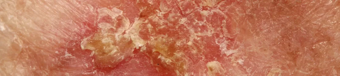 leziune specifica bolii Bowen