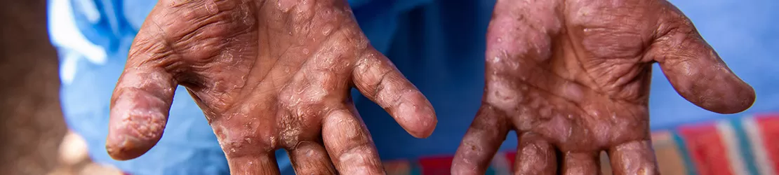 mainile unei persoane care sufera de lepra