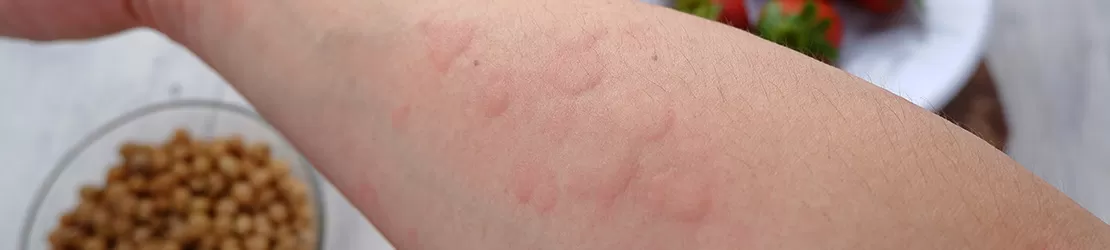 mana unui om care are o reactie alergica manifestata la nivelul pielii
