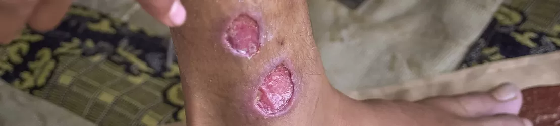 piciorul unei persoane care sufera de leishmanioza