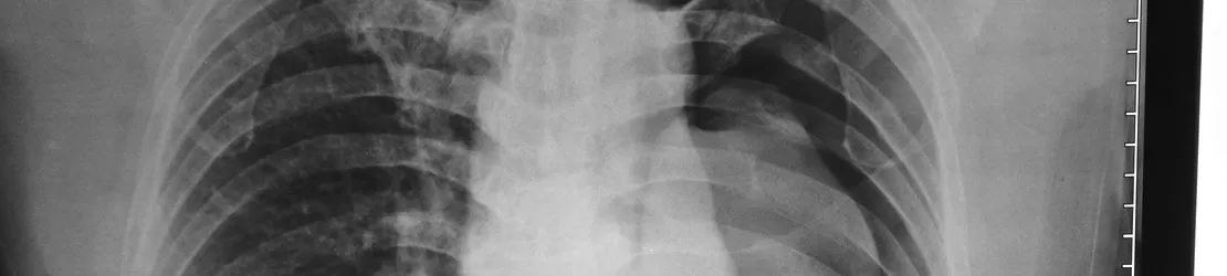 radiografie la pacient cu pneumotorax