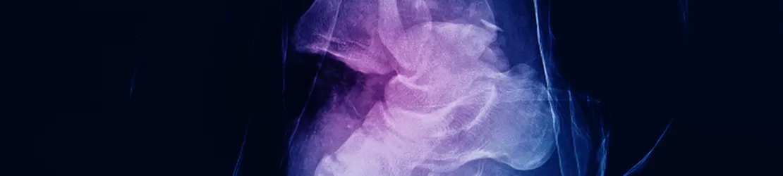 radiografie laterala a unei glezne luxate