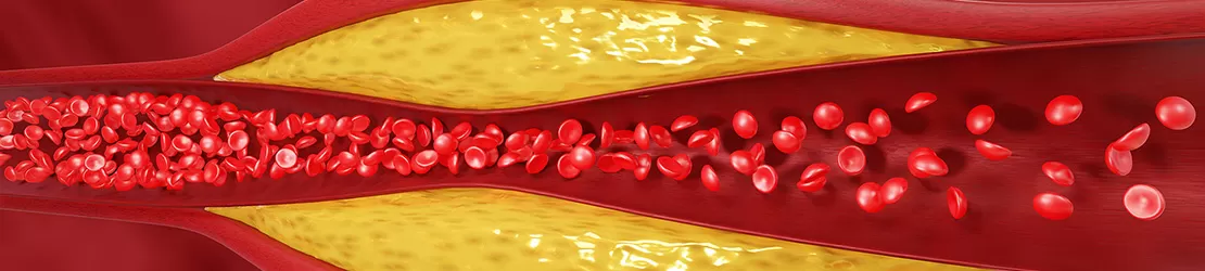 Artera afectata de hiperlipidemie