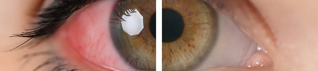 Femeie care prezinta roseata a ochiului, simptom al uveitei