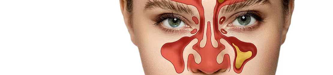 Femeie care sufera de pansinuzita