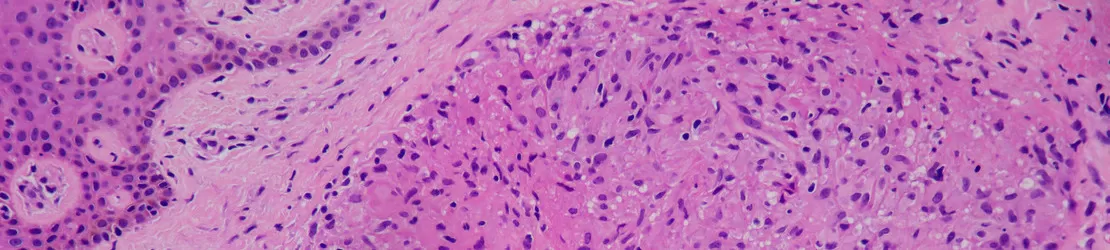 imagine a sarcoidozei pielii la microscop