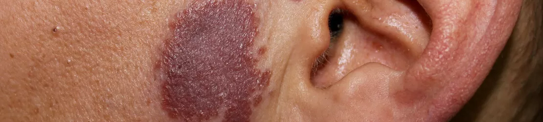 portretul unei persoane care sufera de sarcoidoza