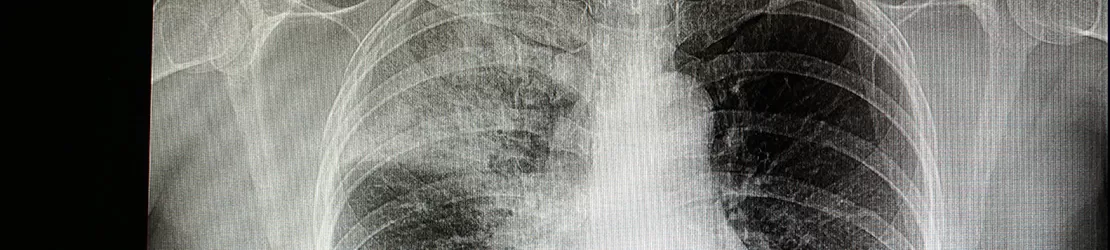 Radiografia unui pacient care sufera de penumonie bacteriana