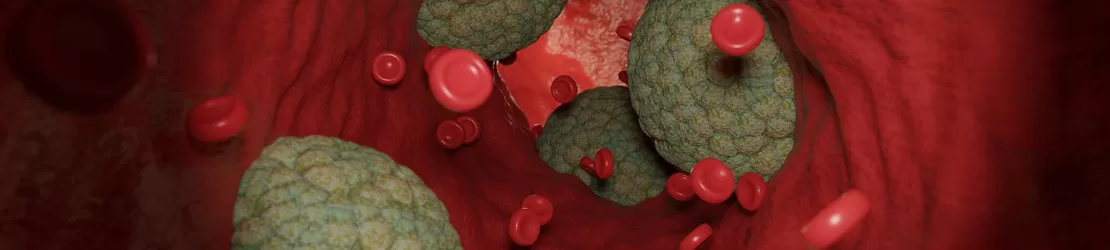 depozite de colesterol pe peretii unui vas de sange