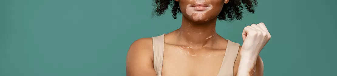 Femeie cu vitiligo
