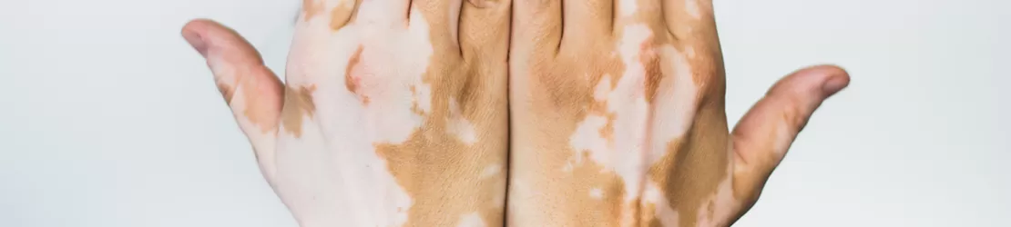 Mainile unei persoane care sufera de vitiligo