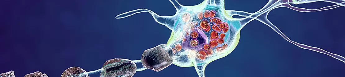 Reprezentare grafica pentru neuroni in cazul bolii Tay-Sachs 