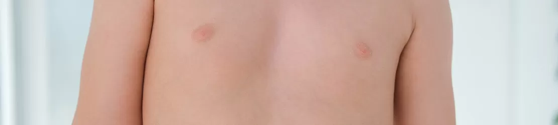 Baiat care sufera de  pectus excavatum