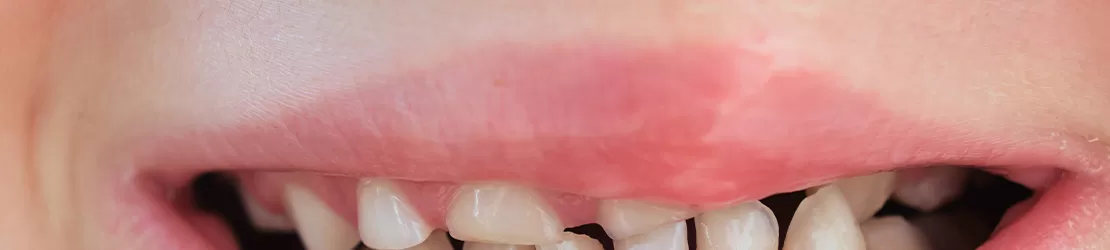 Copil cu operatie pentru gura de lup