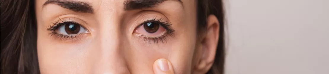Femeie care prezinta simptomele Sindromului Sjogren