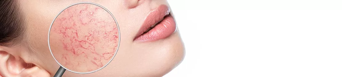 Femeie care sufera de rozacee