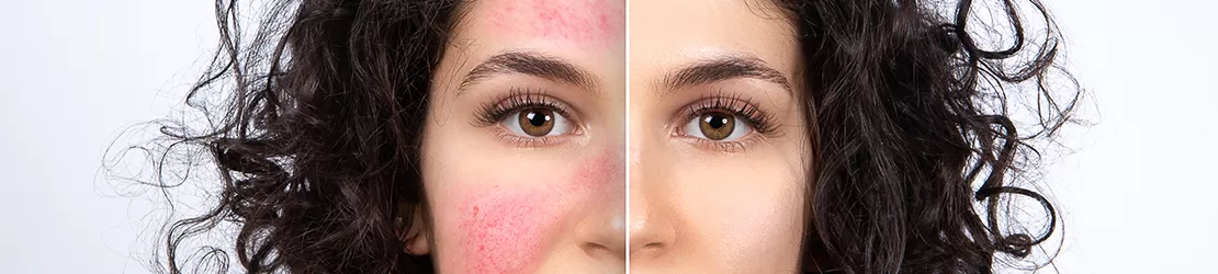 Imagine cu tenul unei femei inainte si dupa urmarea unui tratament pentru rozacee