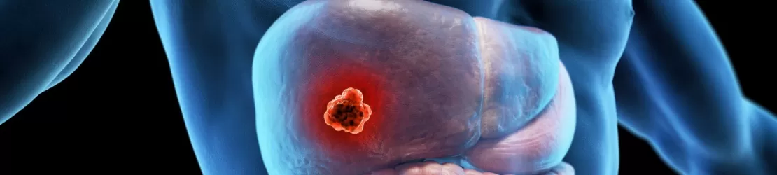 Reprezentare 3D pentru un barbat care are cancer hepatic