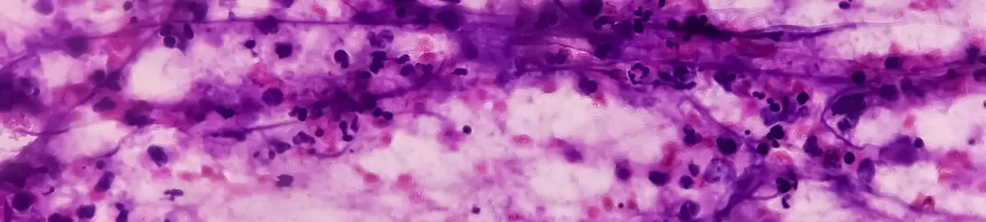 Reprezentare microscopica pentru bacteria care provoaca boala Kikuchi
