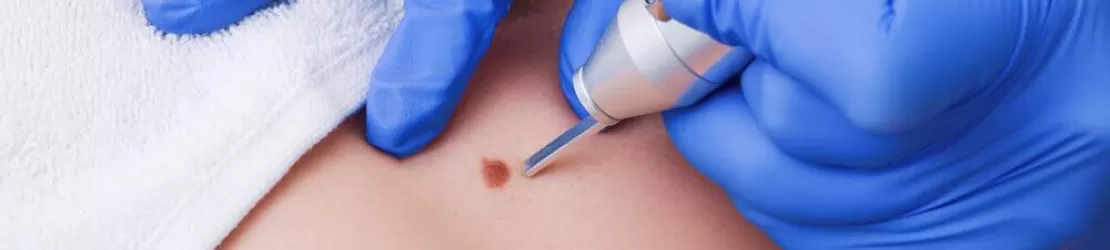 Alunitele ce sunt si cum le identificam pe cele cu potential cancerigen