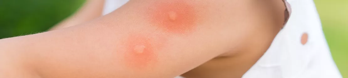 Brat cu ciupituri de tantari inflamate