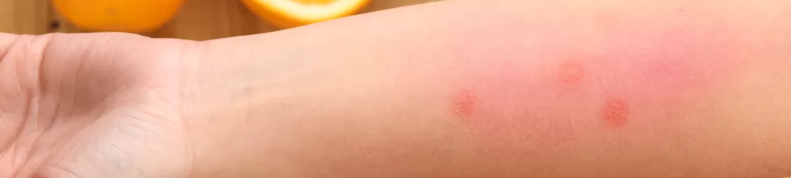 Mana unei femei care prezinta simptome de alergie alimentara