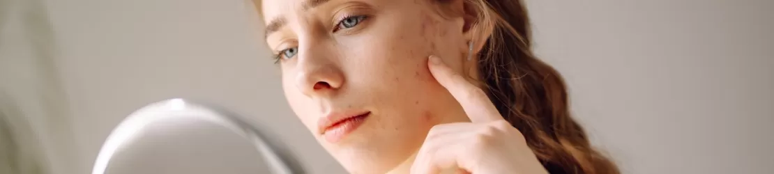 Femeie cu acnee vulgara ce se uita in oglinda