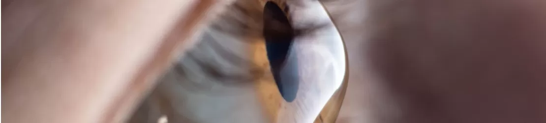 Ochiul unei persoane care sufera de keratocon