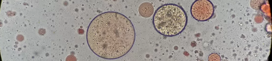 Reprezentare microscopica pentru rezultatul pozitiv al testului de de examinare a grasimii in scaun