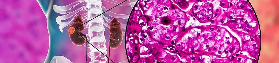 Reprezentare 3D pentru celulele care provoaca un carcinom renal