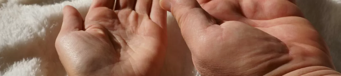 Comparatie intre doua maini, una dintre ele fiind afectata de acromegalie