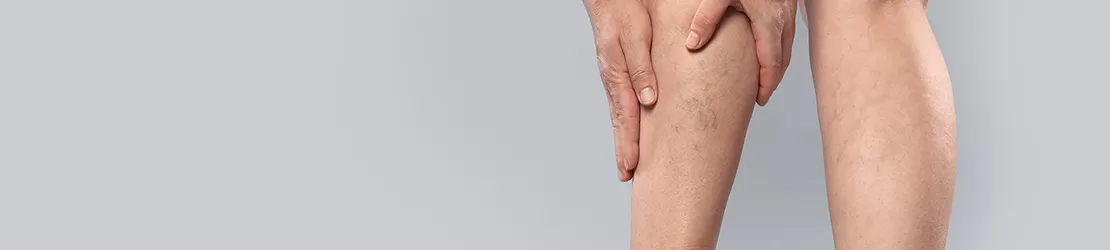 Femeie cu vene varicoase