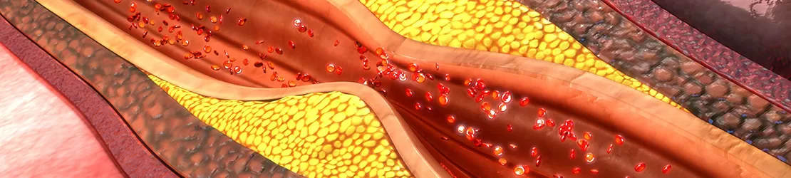 Ilustratie 3D care prezinta o placa arteriala in artera coronariana
