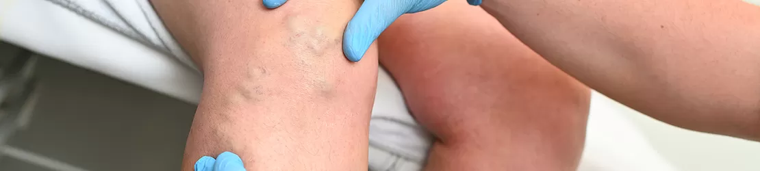 Medicul care examineaza un pacient pentru vene varicoase si probleme vasculare