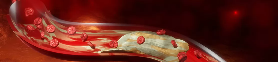 Ilustratie 3D a bolii arterelor coronare, evidentiind acumularea placii in vasele de sange.