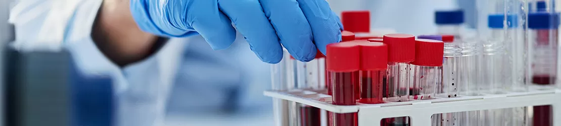 Test de sange pentru depistarea argirozei